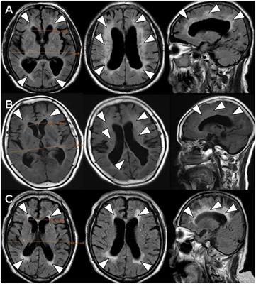 Susceptibility Weighted Imaging (SWI) Recommended as a Regular Magnetic Resonance Diagnosis for Vascular Dementia to Identify Independent Idiopathic Normal Pressure Hydrocephalus Before Ventriculo-Peritoneal (V-P) Shunt Treatment: A Case Study